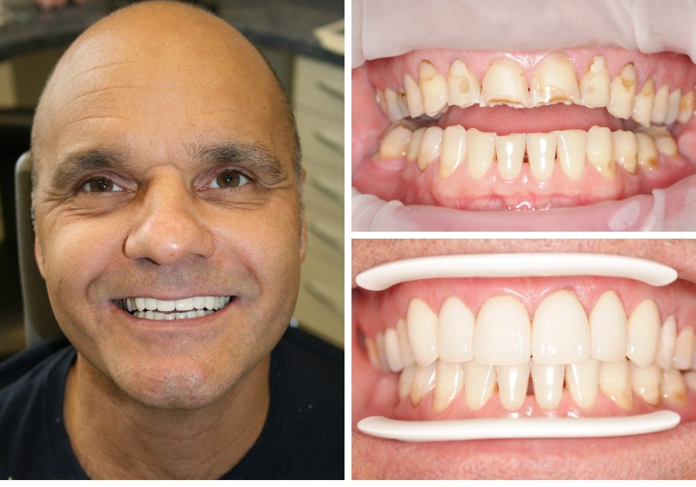 Before and after crowns treatment
