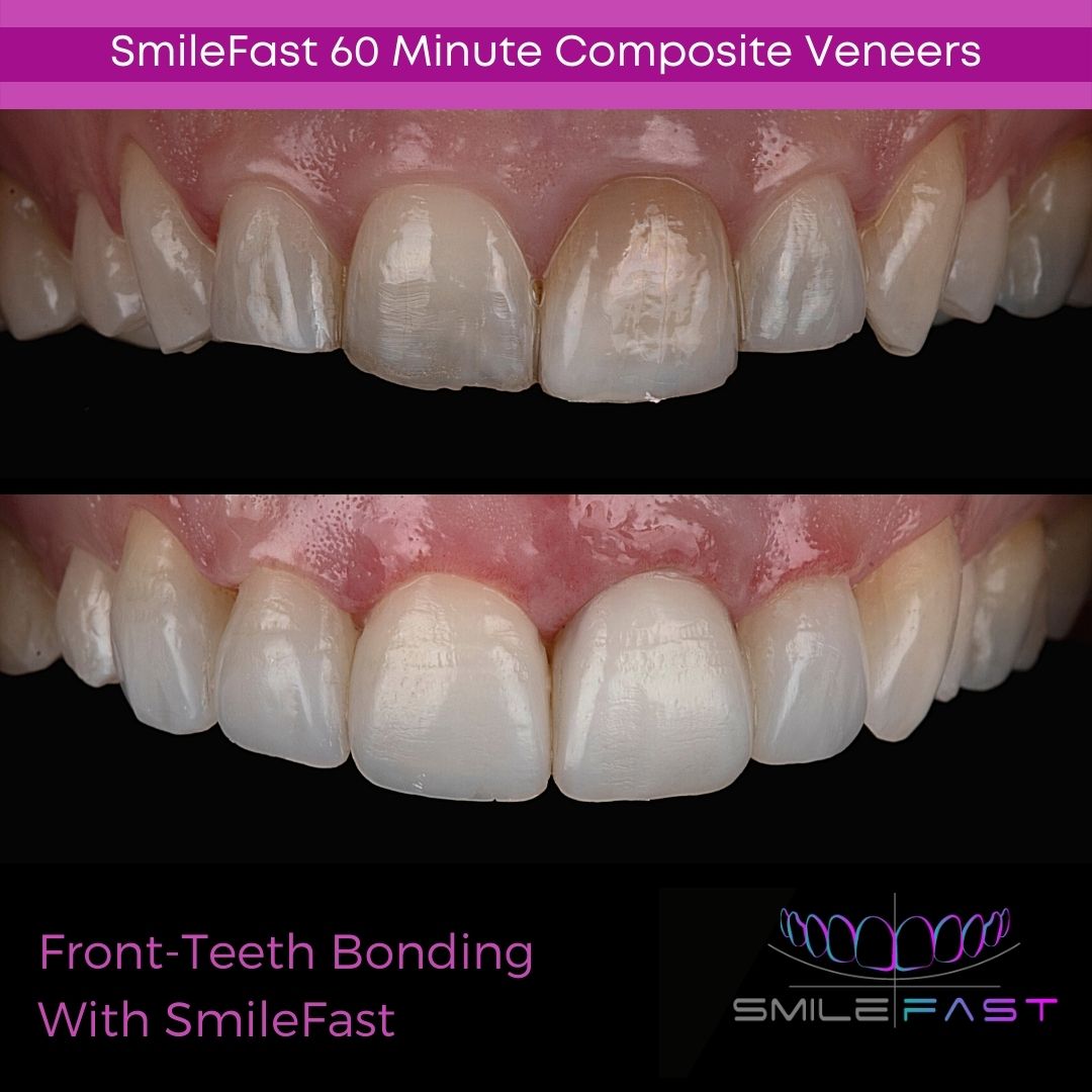 Introducing Smilefast – Fast, Affordable Veneers